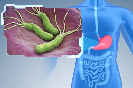 Exploring Helicobacter pylori: A Hidden Threat to Stomach He