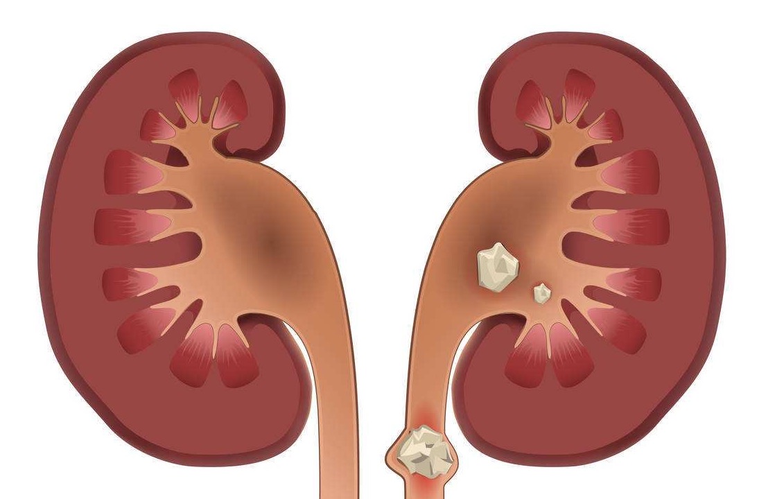 Get rid of the pain of kidney stones, understand the causes 