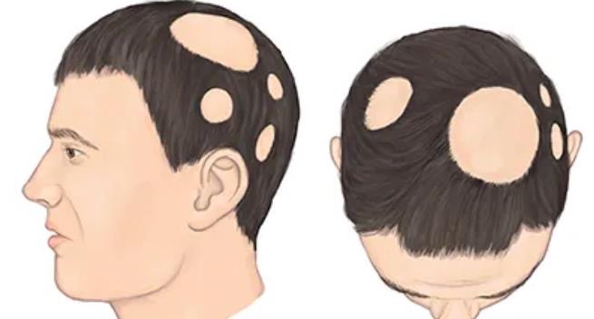 Hair leaving home? The Dangers of Spot Baldness