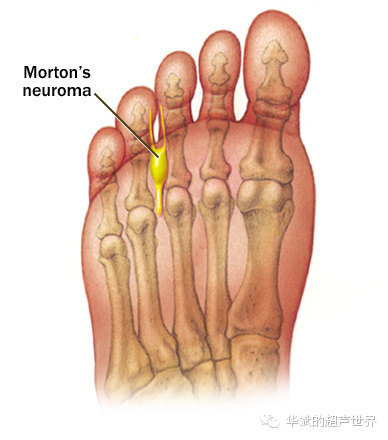 Foot pain may be a disease that must be attention to