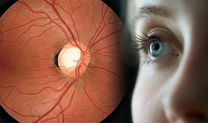 Glaucoma: If Your Family Has It, You Should Pay Attention To