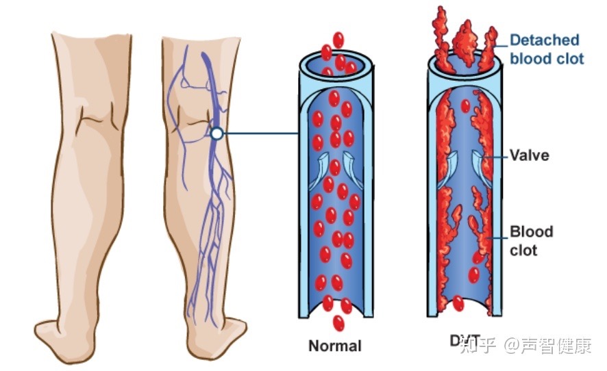 Your legs are always swollen for no reason, you may be suffe